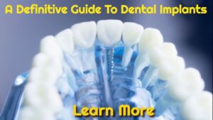 A Definitive Guide To Dental Implant Surgery