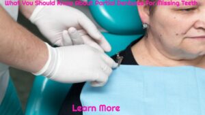 What You Should Know About Partial Dentures