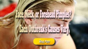 Face, Neck, or Forehead Pimples? Each Outbreak’s Causes Vary
