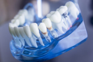 model of lower jaw and teeth