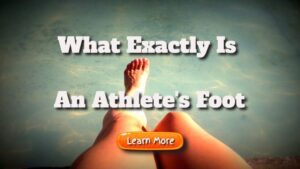 What Exactly Is An Athlete’s Foot – What Are The Indications