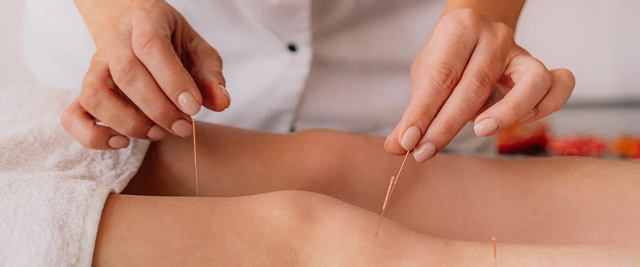Acupuncture treatment session