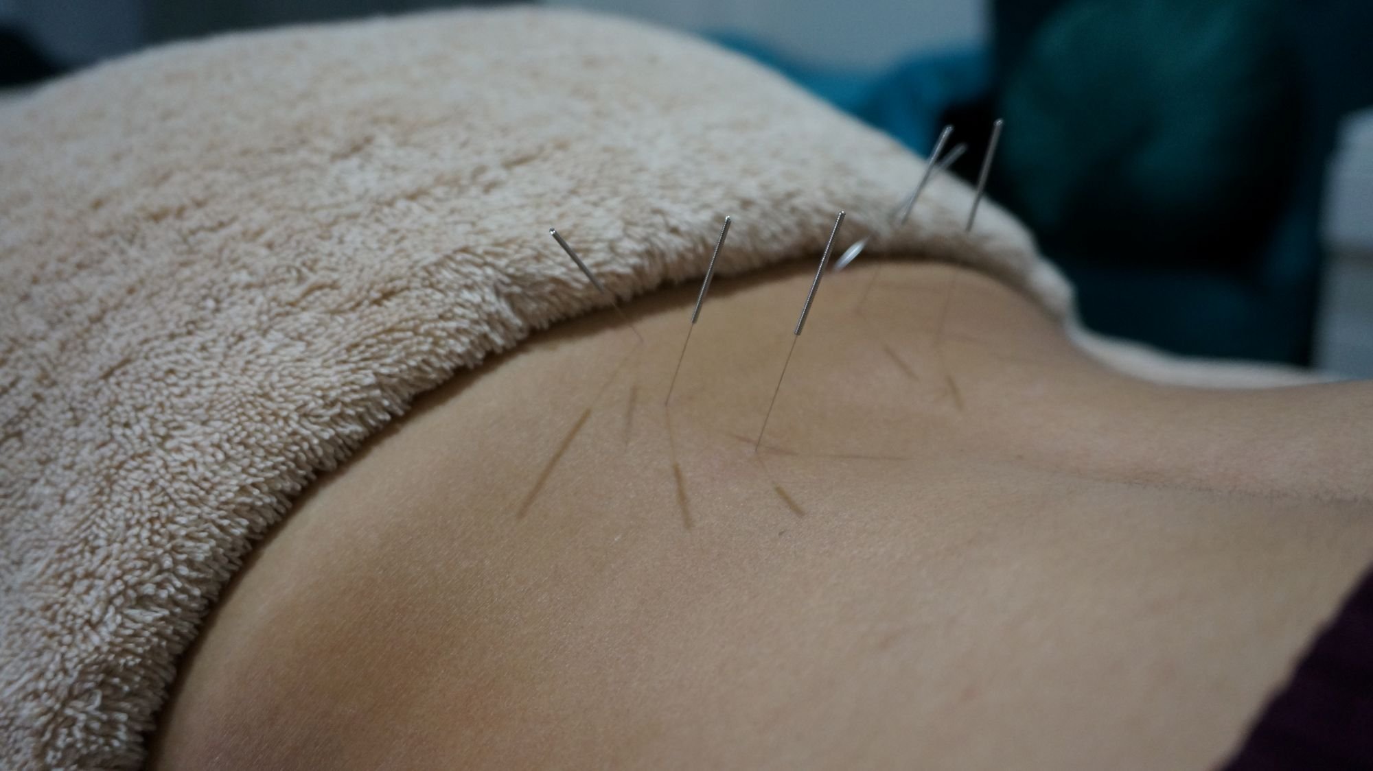 Acupuncture treatment room, designed for relaxation